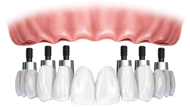 All-on-6 Implant Dentures